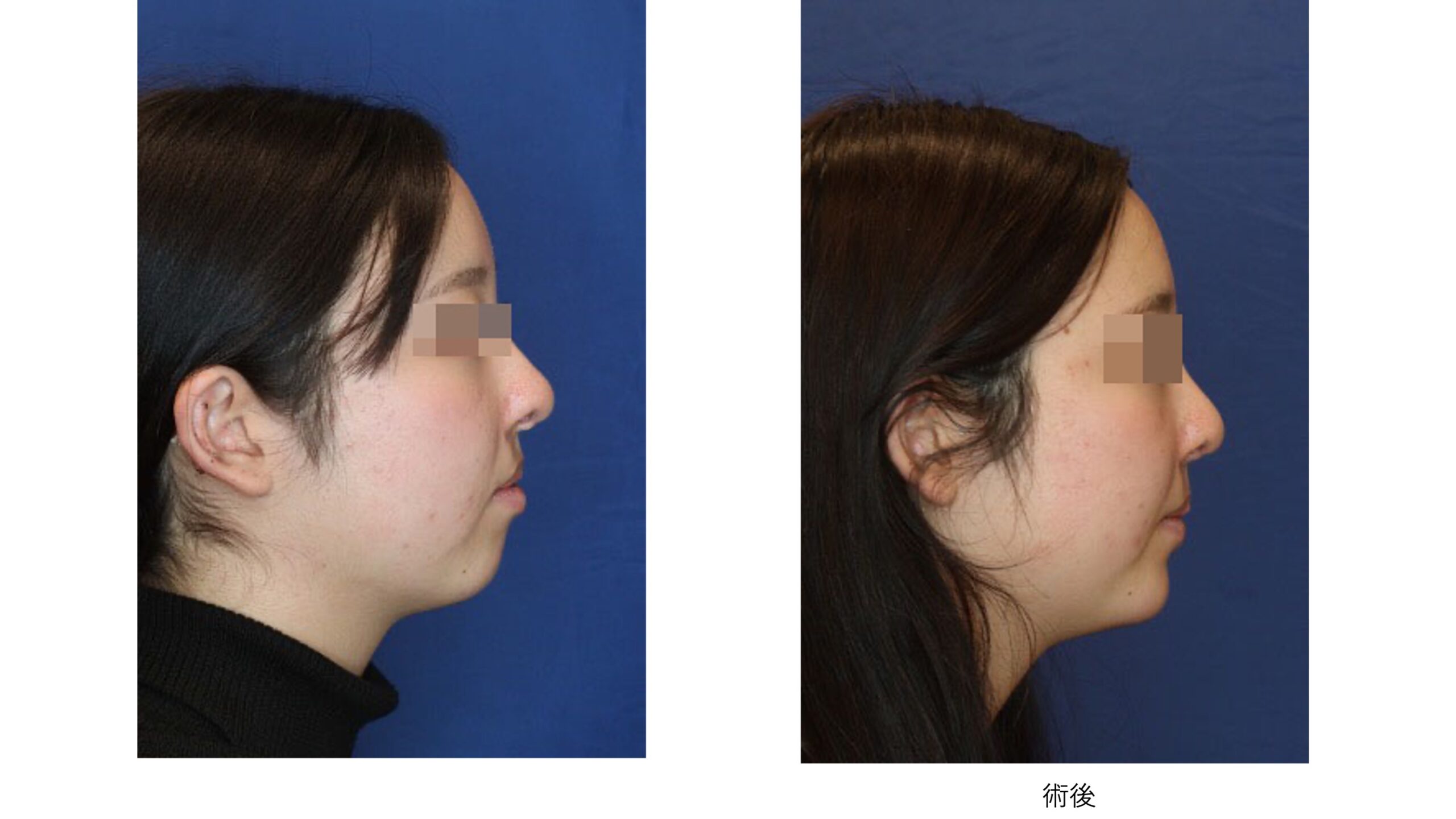 右側唇裂の鼻変形に対する鼻オトガイ修正術