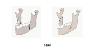 SSROとIVRO