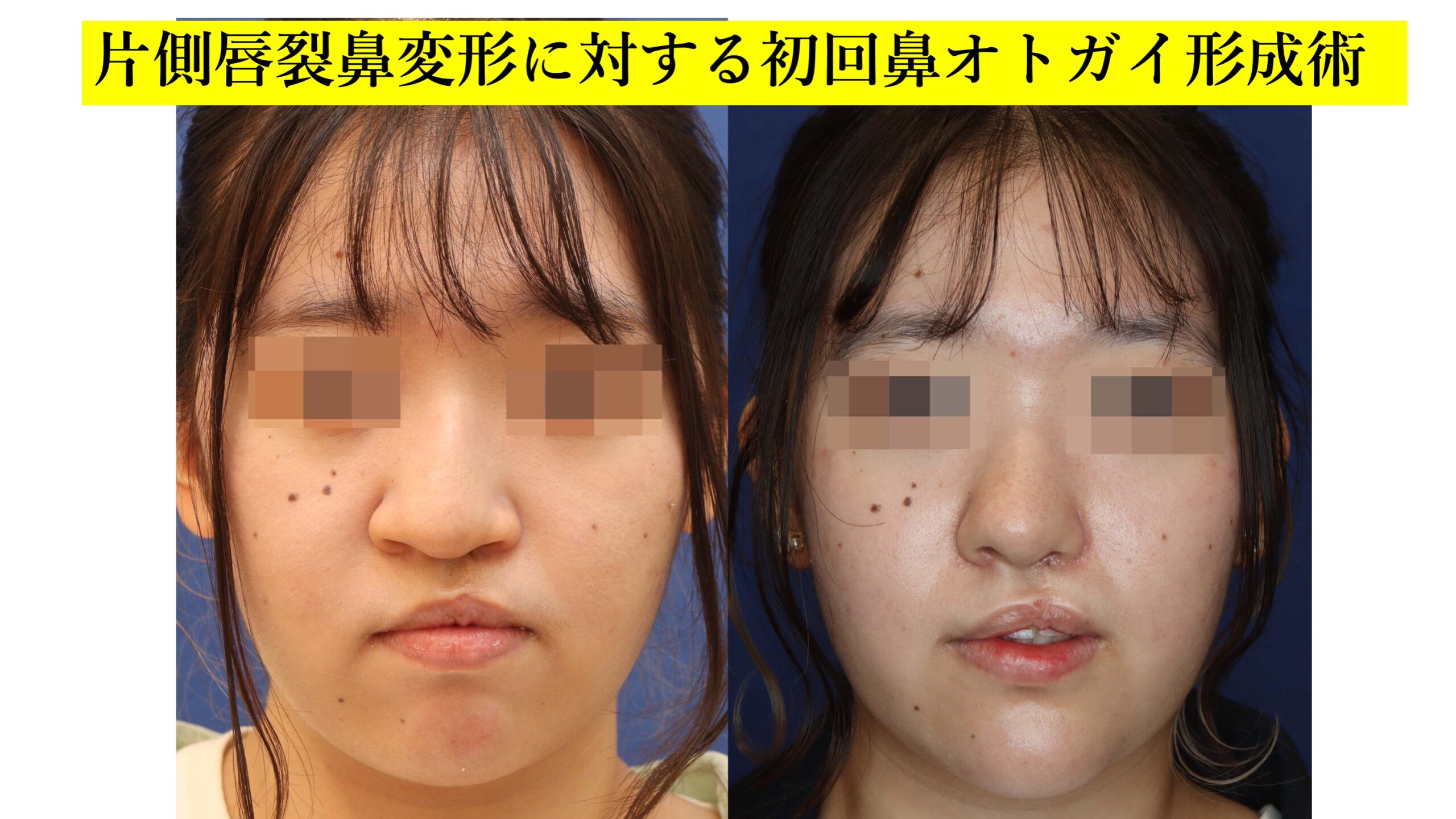 片側唇裂鼻変形に対する初回鼻オトガイ形成術