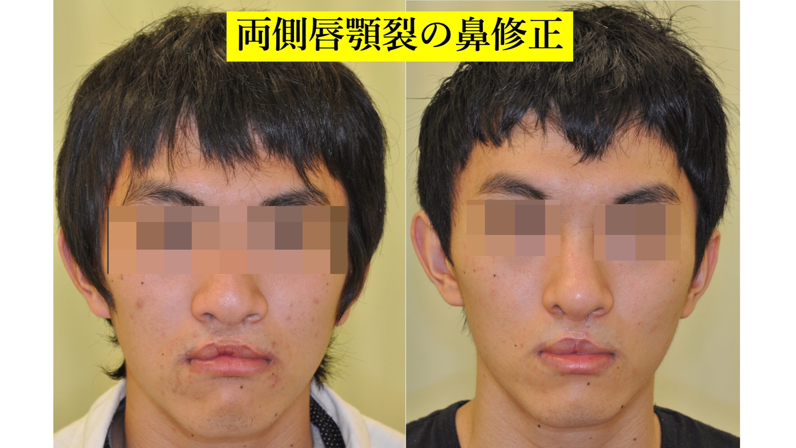 両側唇顎裂の鼻修正