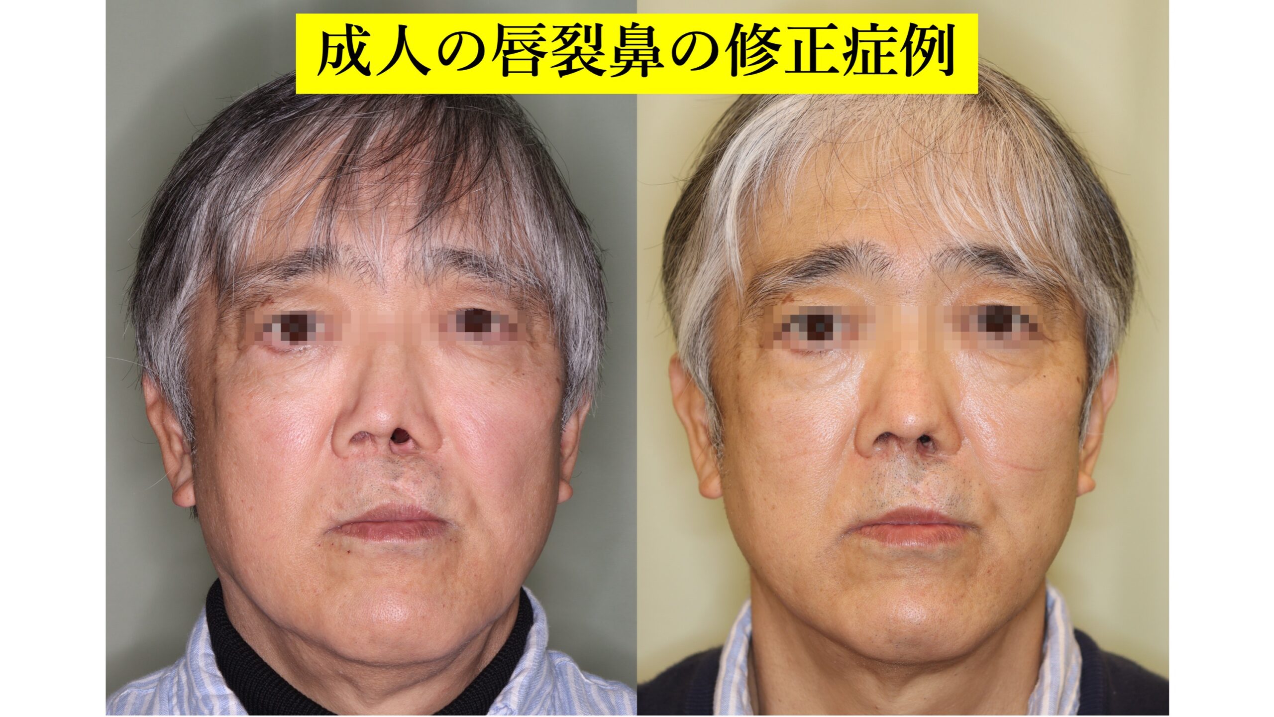 成人の唇裂鼻の修正症例
