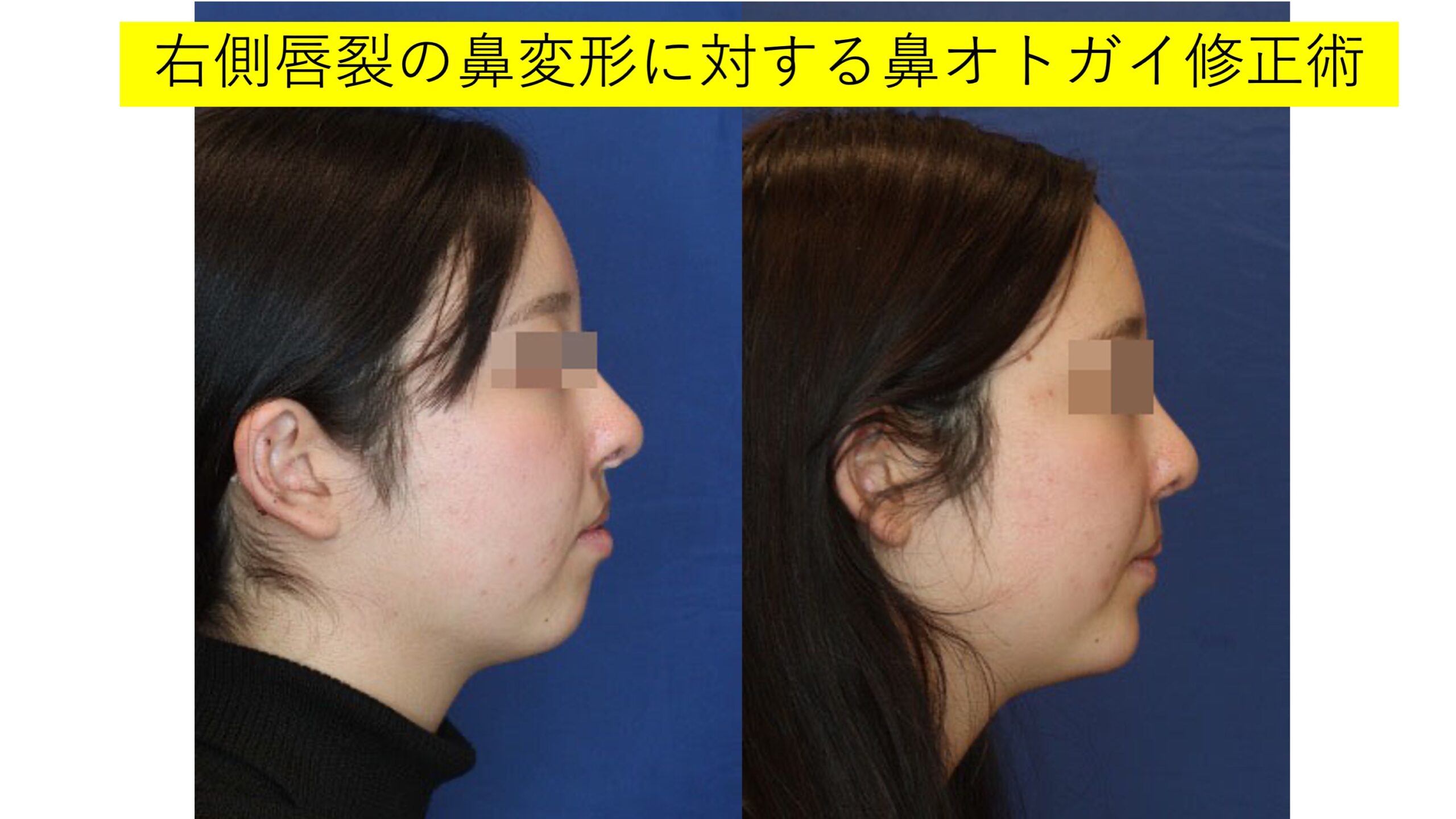 右側唇裂の鼻変形に対する鼻オトガイ修正術