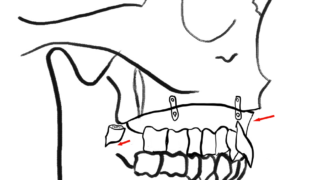 上顎前突症の治療（上顎の後方、後上方移動）について