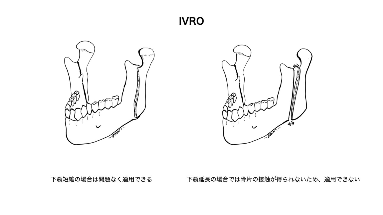 SSROとIVRO - 淀川キリスト教病院 形成外科・小児形成外科