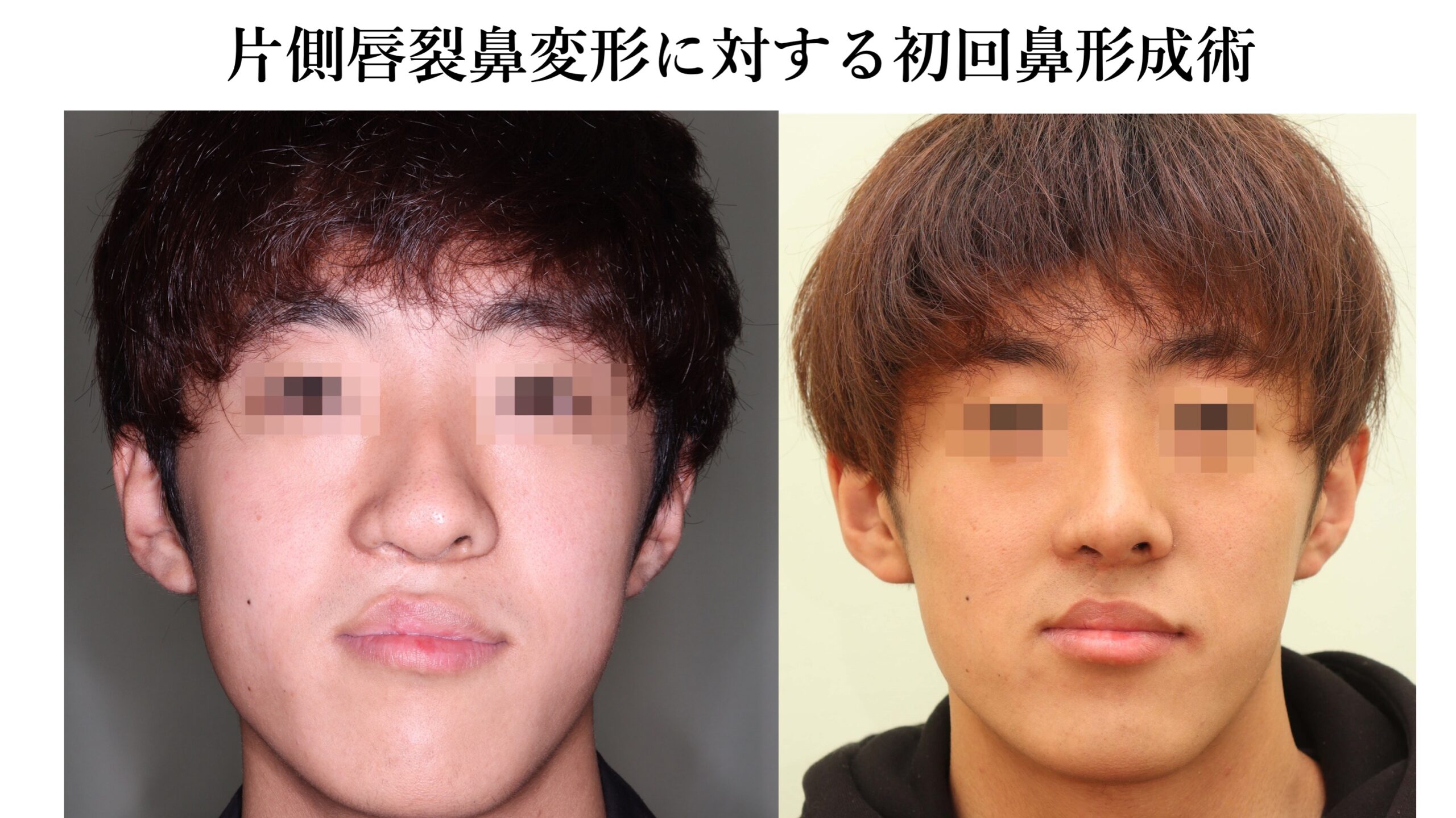 片側唇裂鼻変形に対する初回鼻形成術