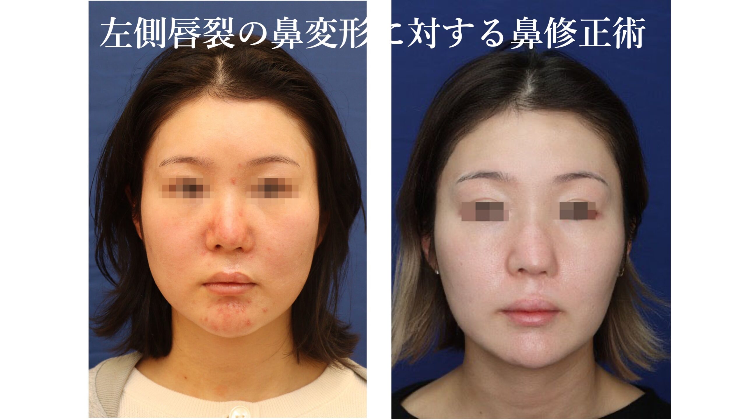 左側唇裂の鼻変形に対する鼻修正術
