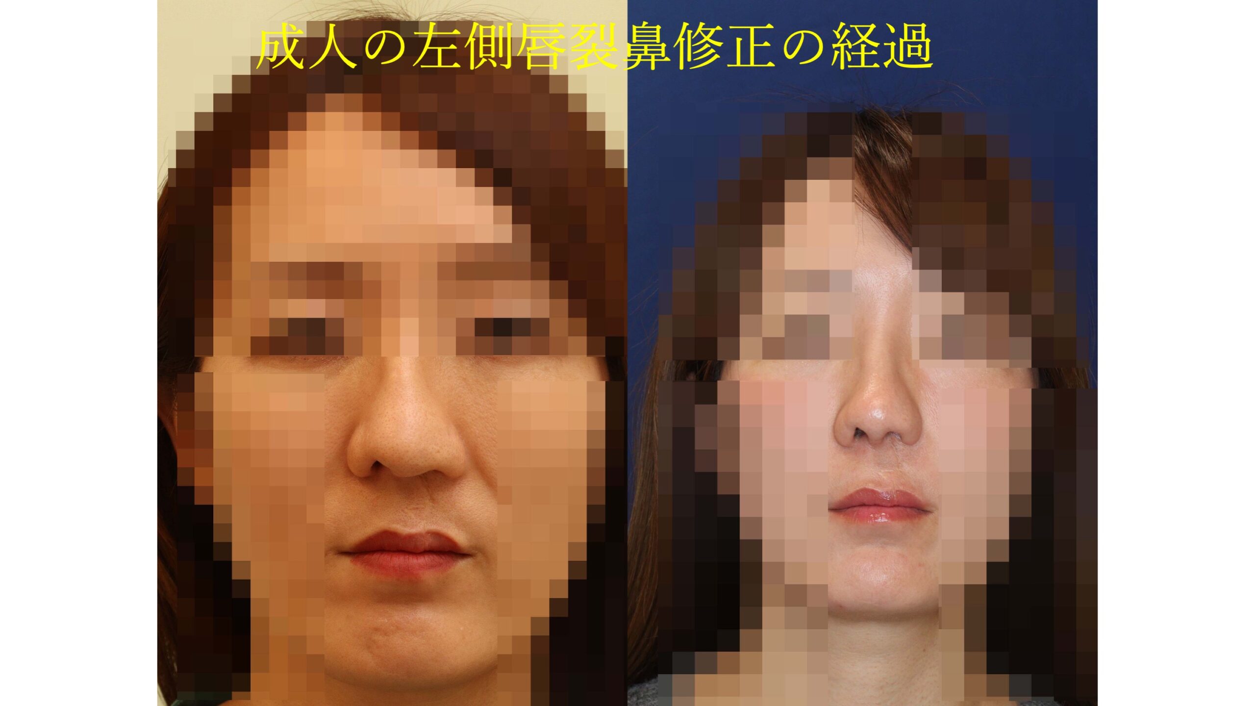 成人の左側唇裂鼻修正の経過