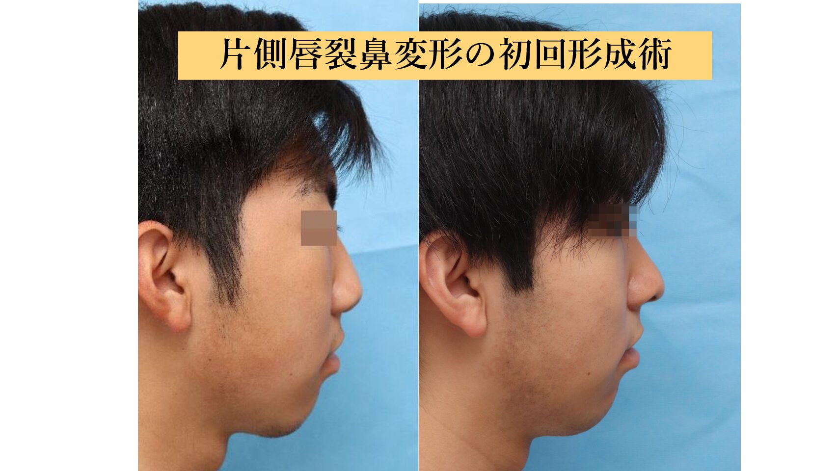 片側唇顎口蓋裂に対する初回鼻形成術
