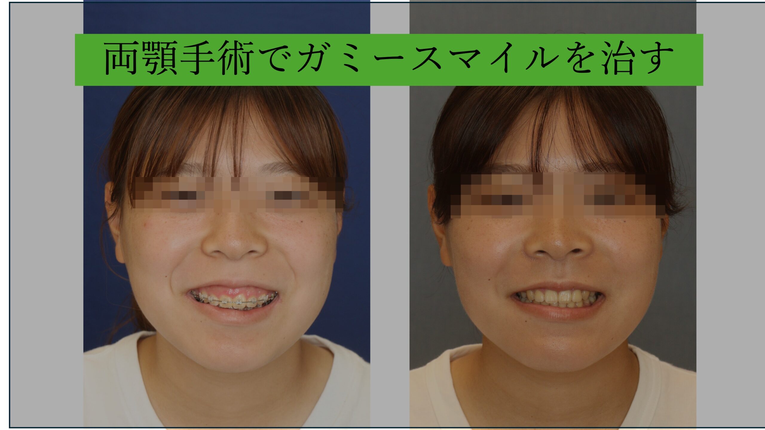 両顎手術でガミースマイルを治す