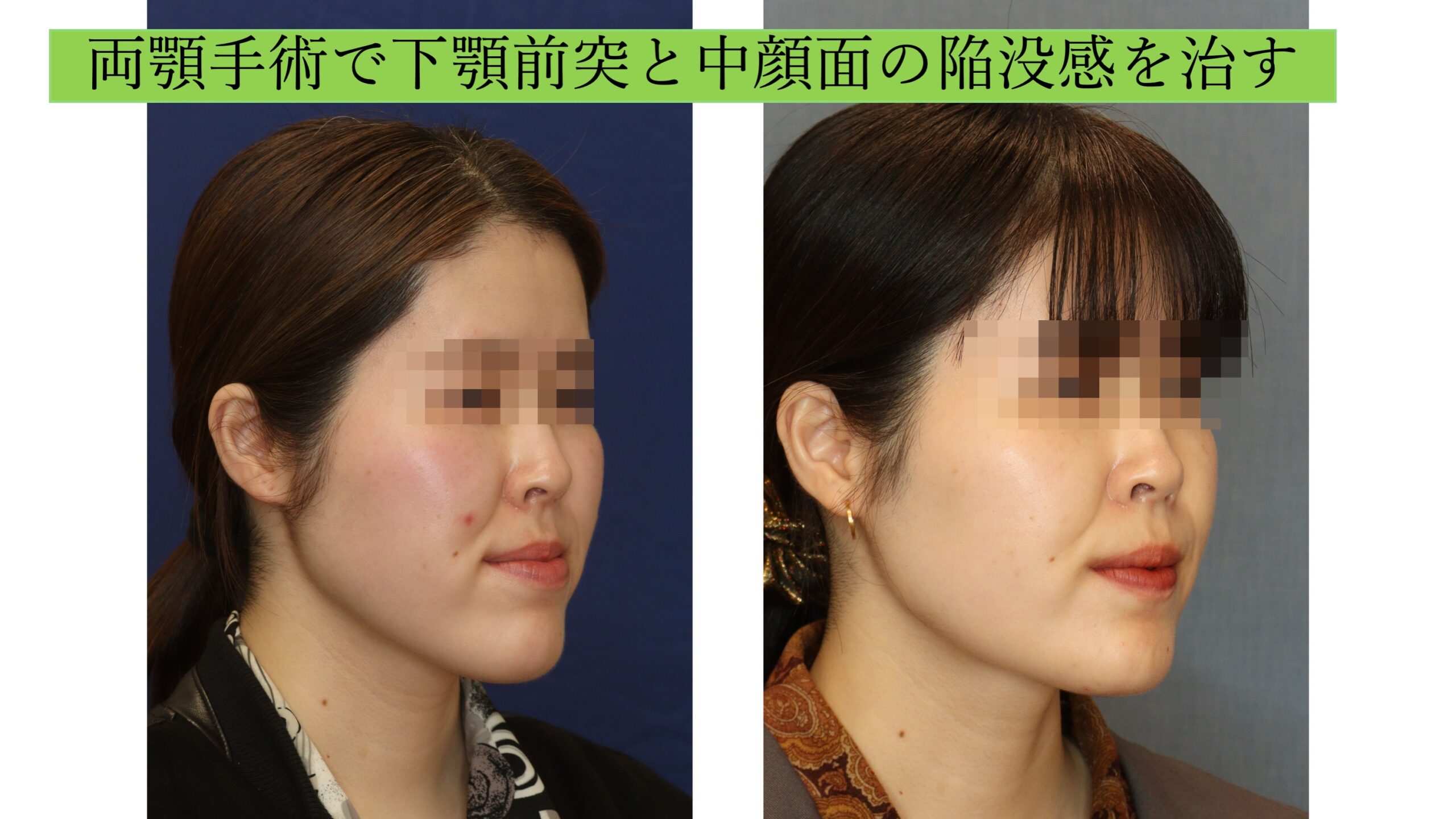 両顎手術で下顎前突と中顔面の陥没感を治す