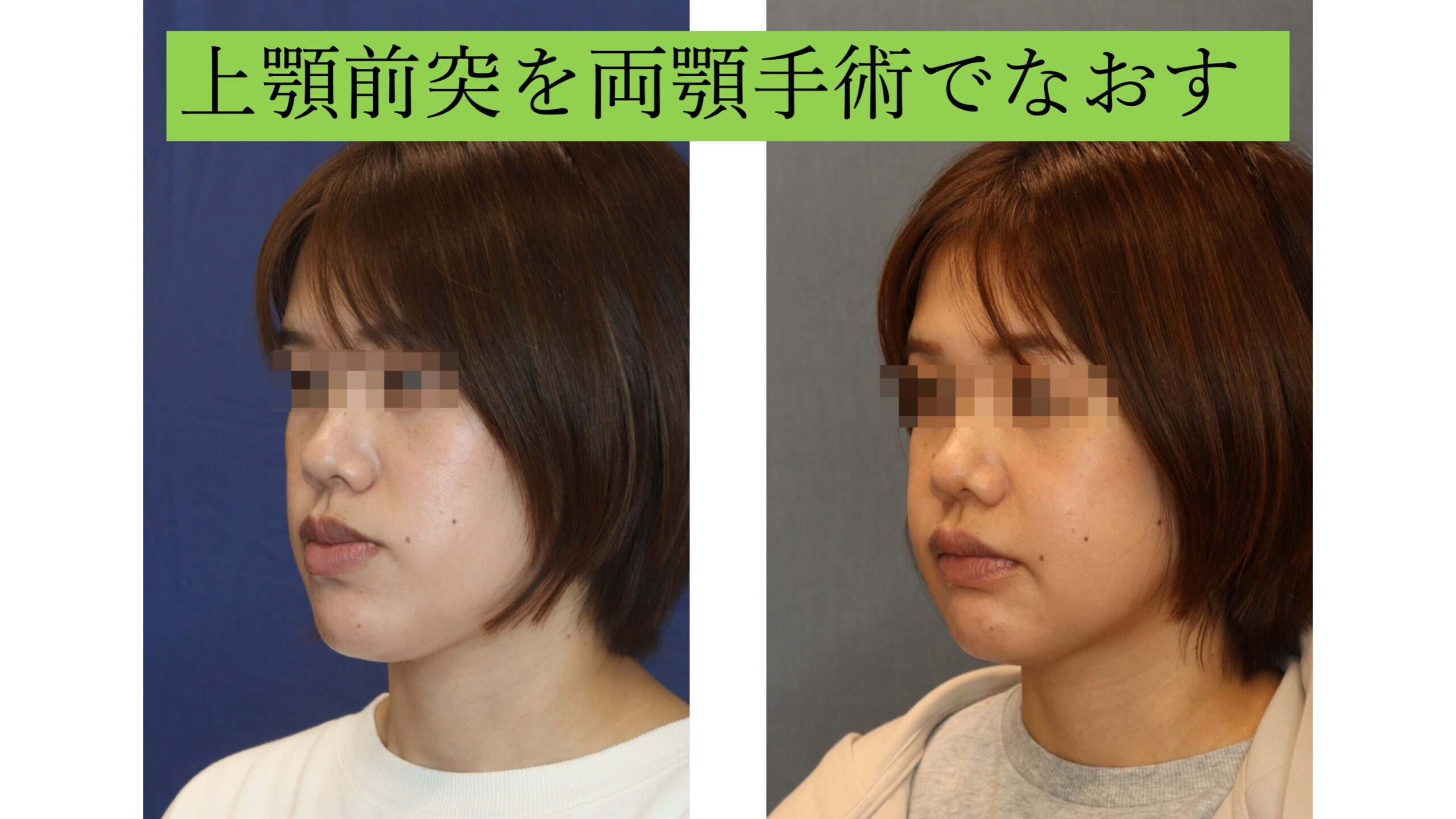 下顎前突を両顎手術で治す