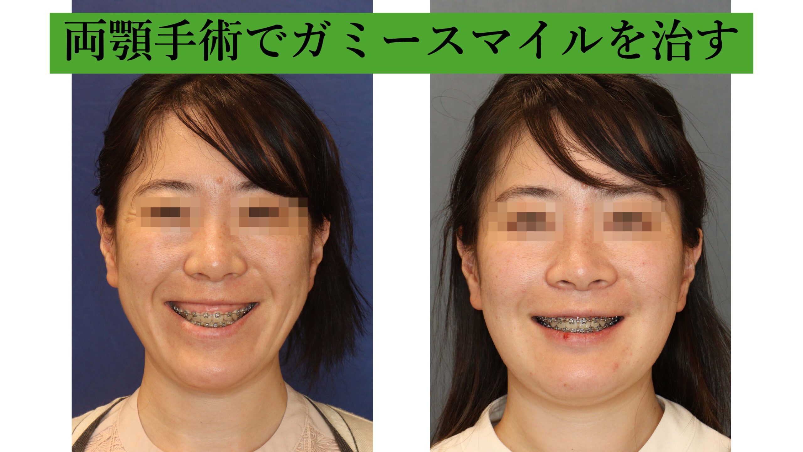 両顎手術でガミースマイルをなおす