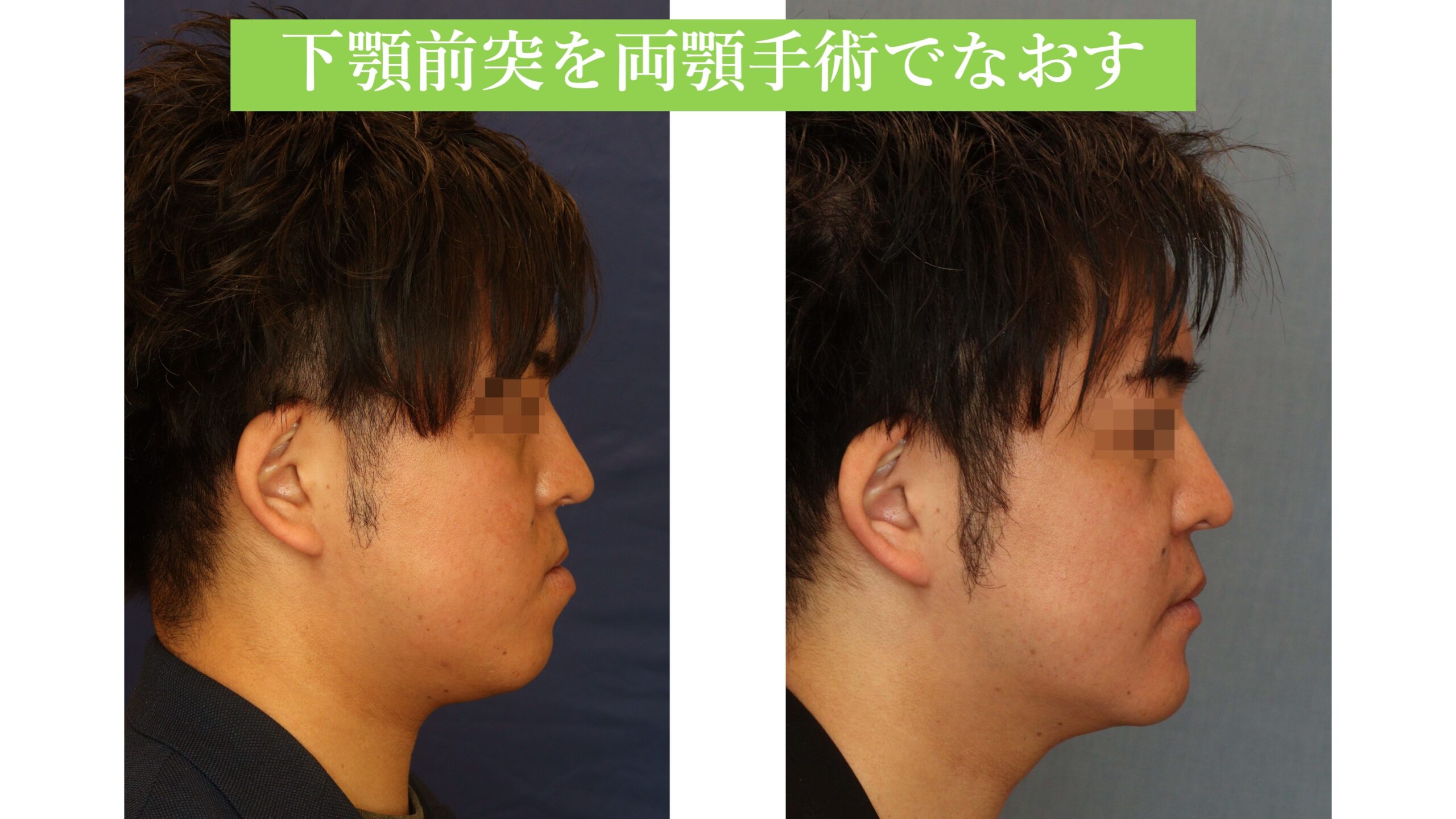 下顎前突を伴う顎変形症に対する両顎手術の1例