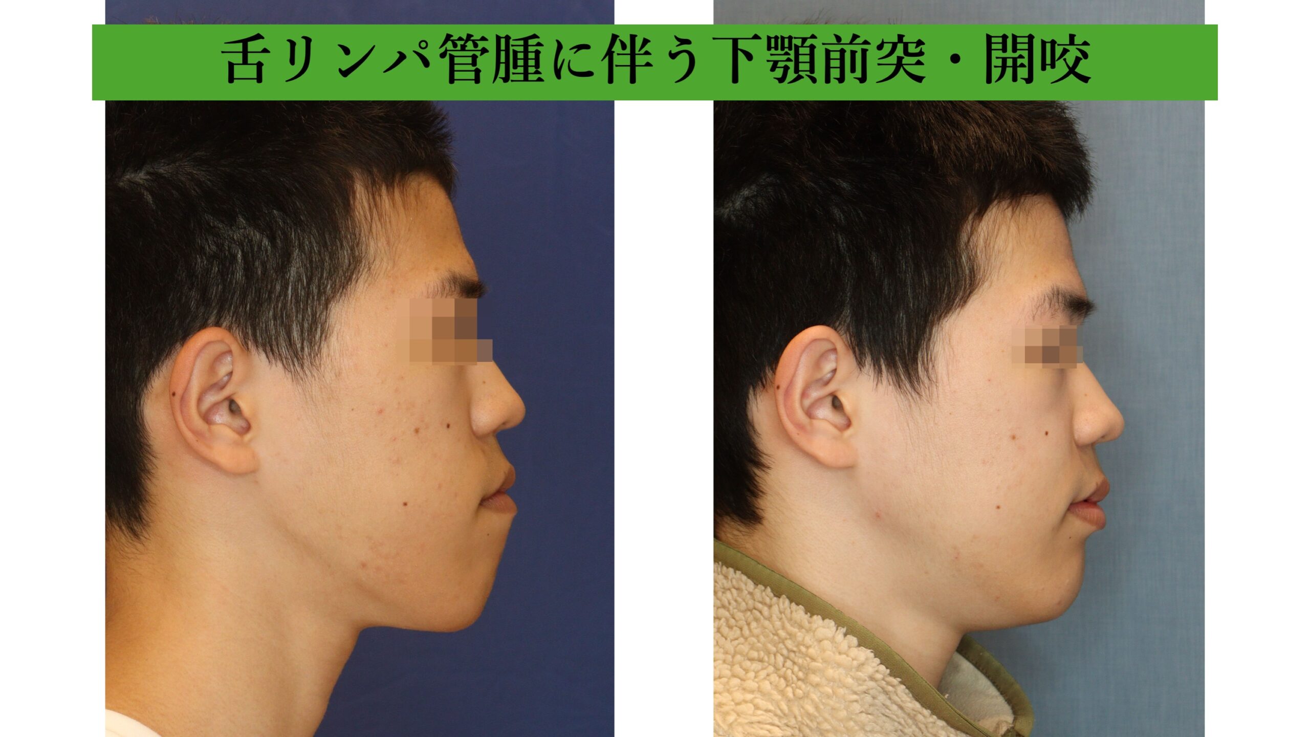 舌リンパ管腫に起因する骨格性下顎前突・開咬に対する両顎手術の一例