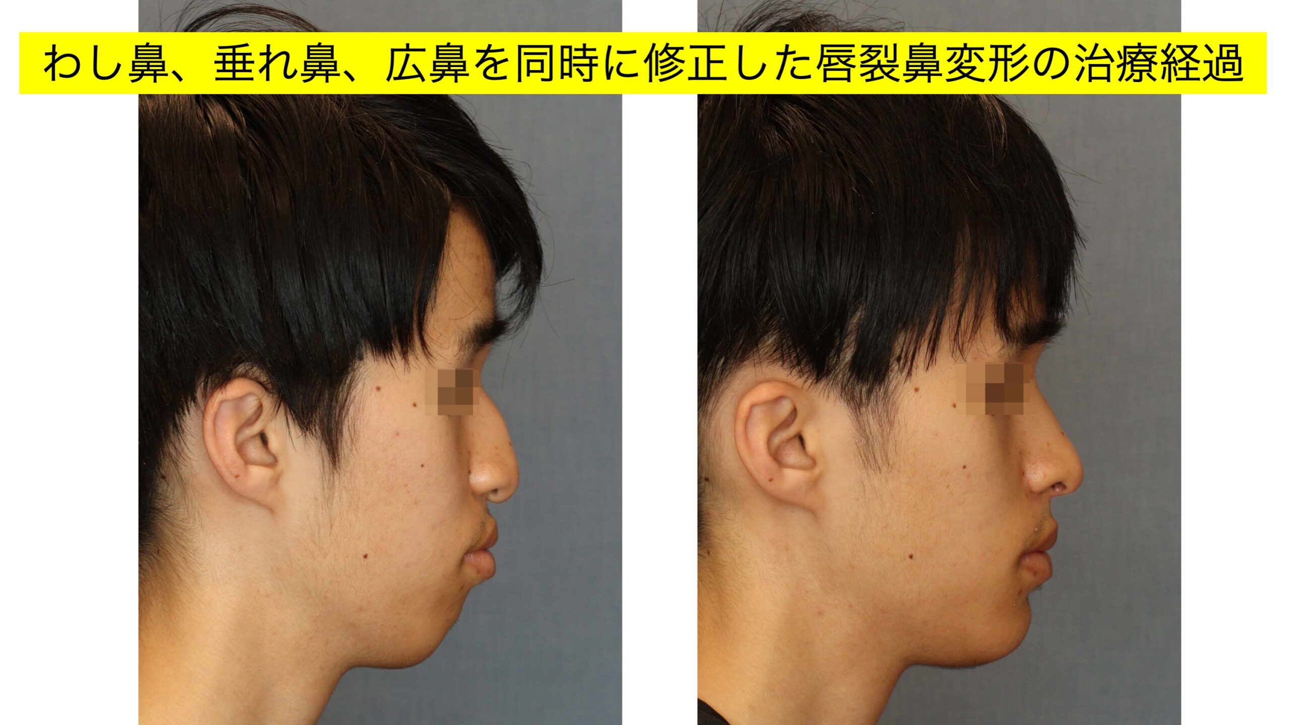 わし鼻、垂れ鼻および広鼻の修正を行なった唇裂鼻変形の一例