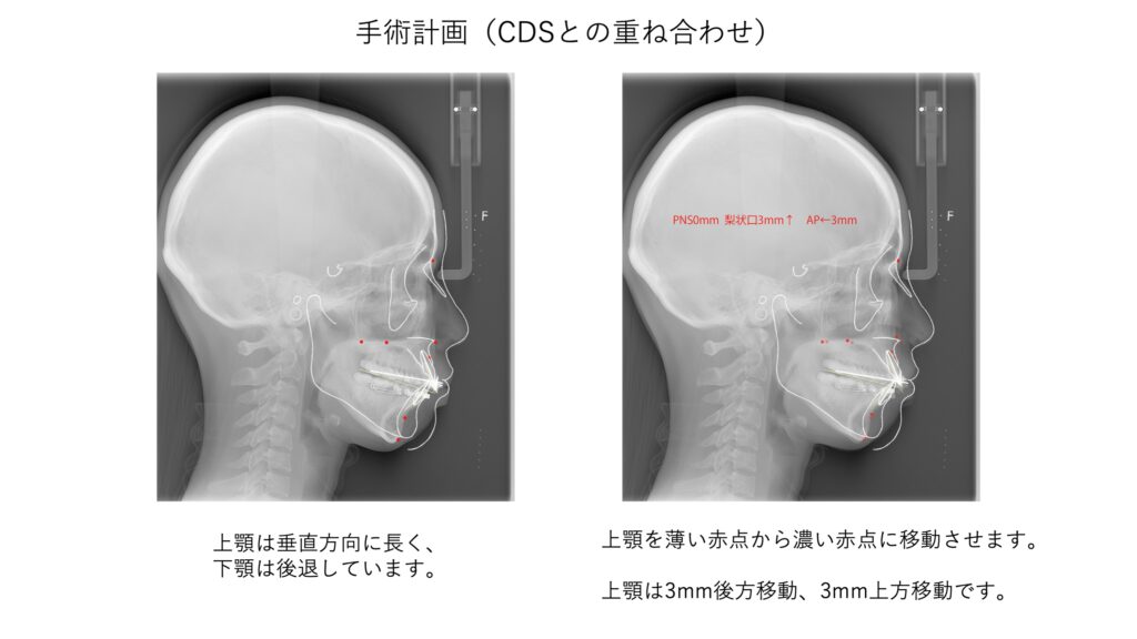 セファロとCDSの重ね合わせ