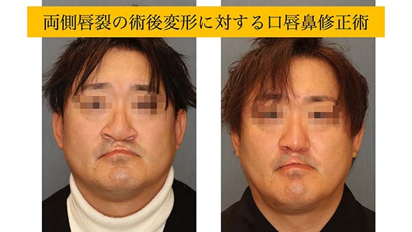 鼻翼幅の広い両側唇裂鼻変形に対する修正術