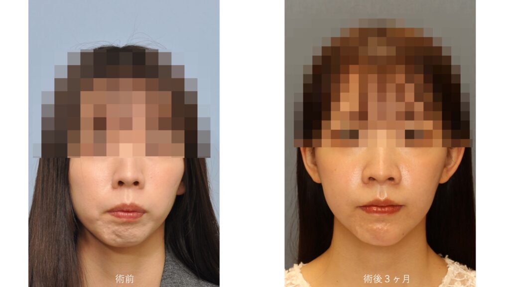 ガミースマイルと口ゴボを呈する女性の術前術後比較写真