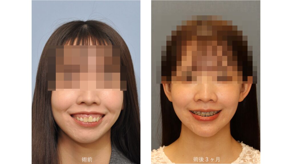 ガミースマイルと口ゴボを呈する女性の術前術後比較写真