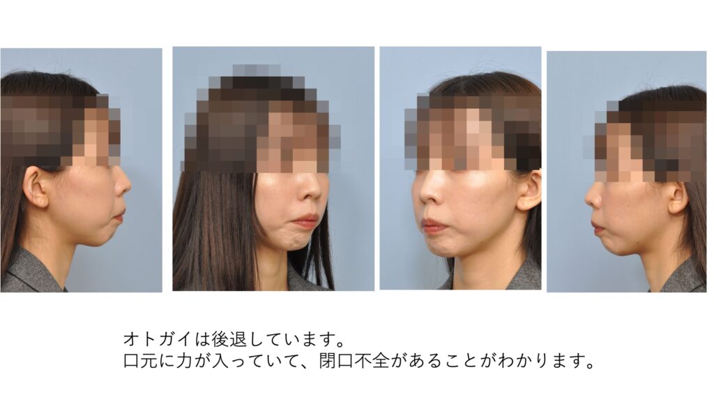ガミースマイルと口ゴボを呈する女性の斜めと側貌写真