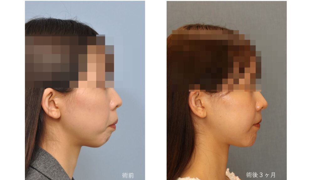 ガミースマイルと口ゴボを呈する女性の術前術後比較写真