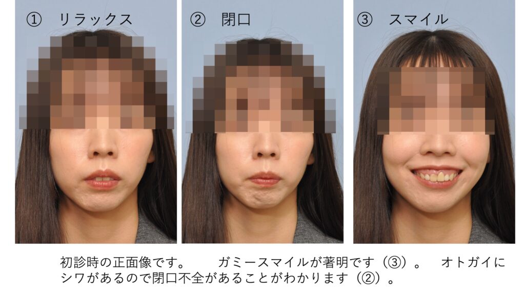 ガミースマイルと口ゴボを呈する女性の術前正面写真