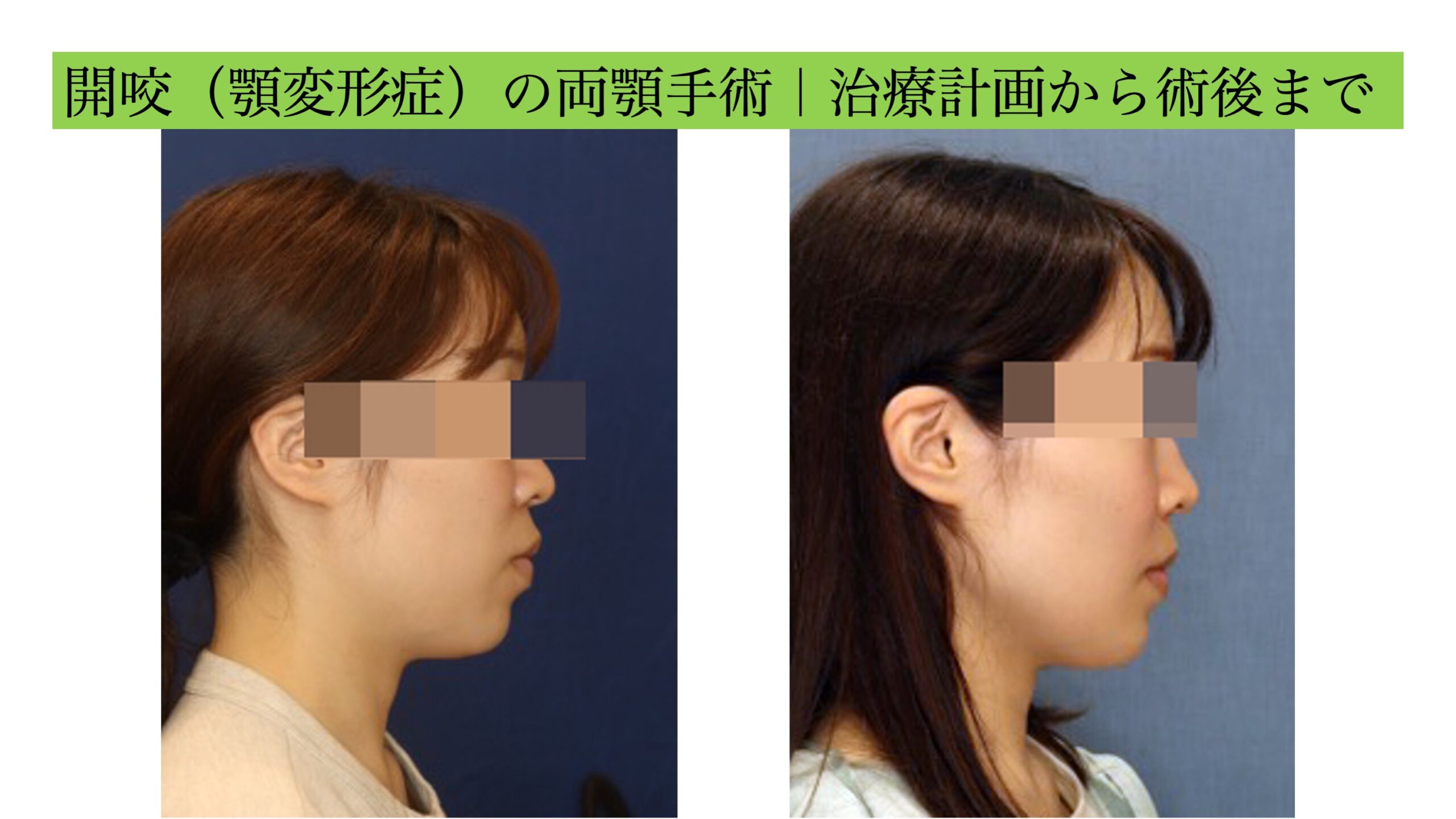 開咬（顎変形症）の両顎手術｜治療計画から術後まで