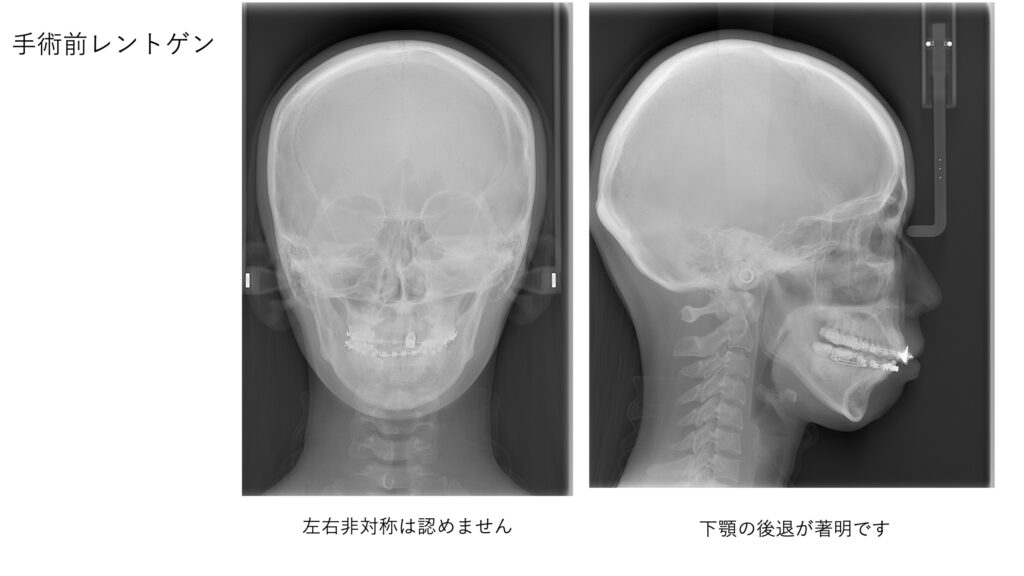 顎変形症患者の術前セファログラム