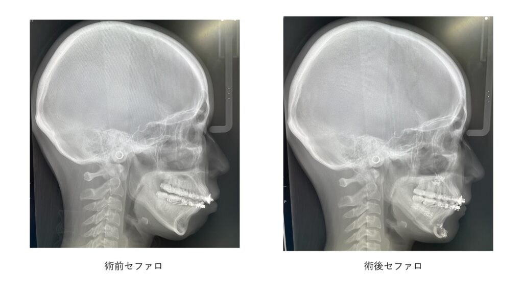 術前後のレントゲン