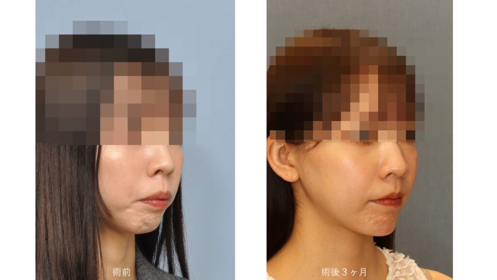 ガミースマイルと口ゴボを呈する女性の術前術後比較写真