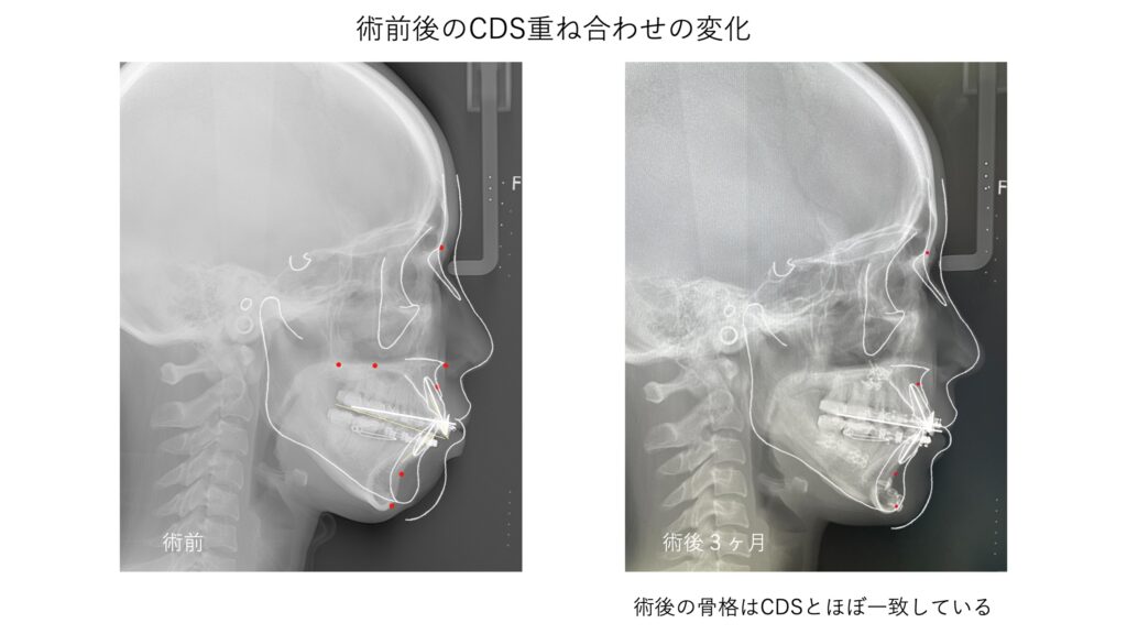 術前後のレントゲン