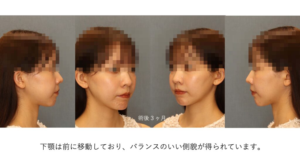 ガミースマイルと口ゴボを呈する女性の術後側貌および斜位写真