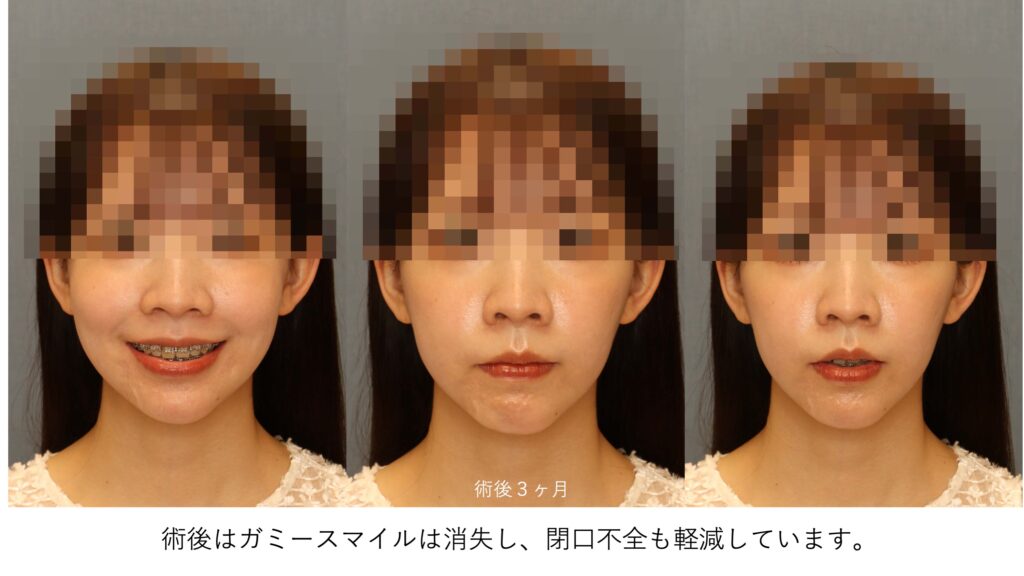 ガミースマイルと口ゴボを呈する女性の術後正面写真