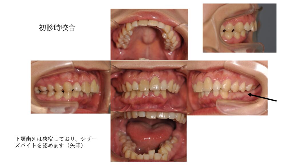 シザーズバイトを呈する口腔内写真