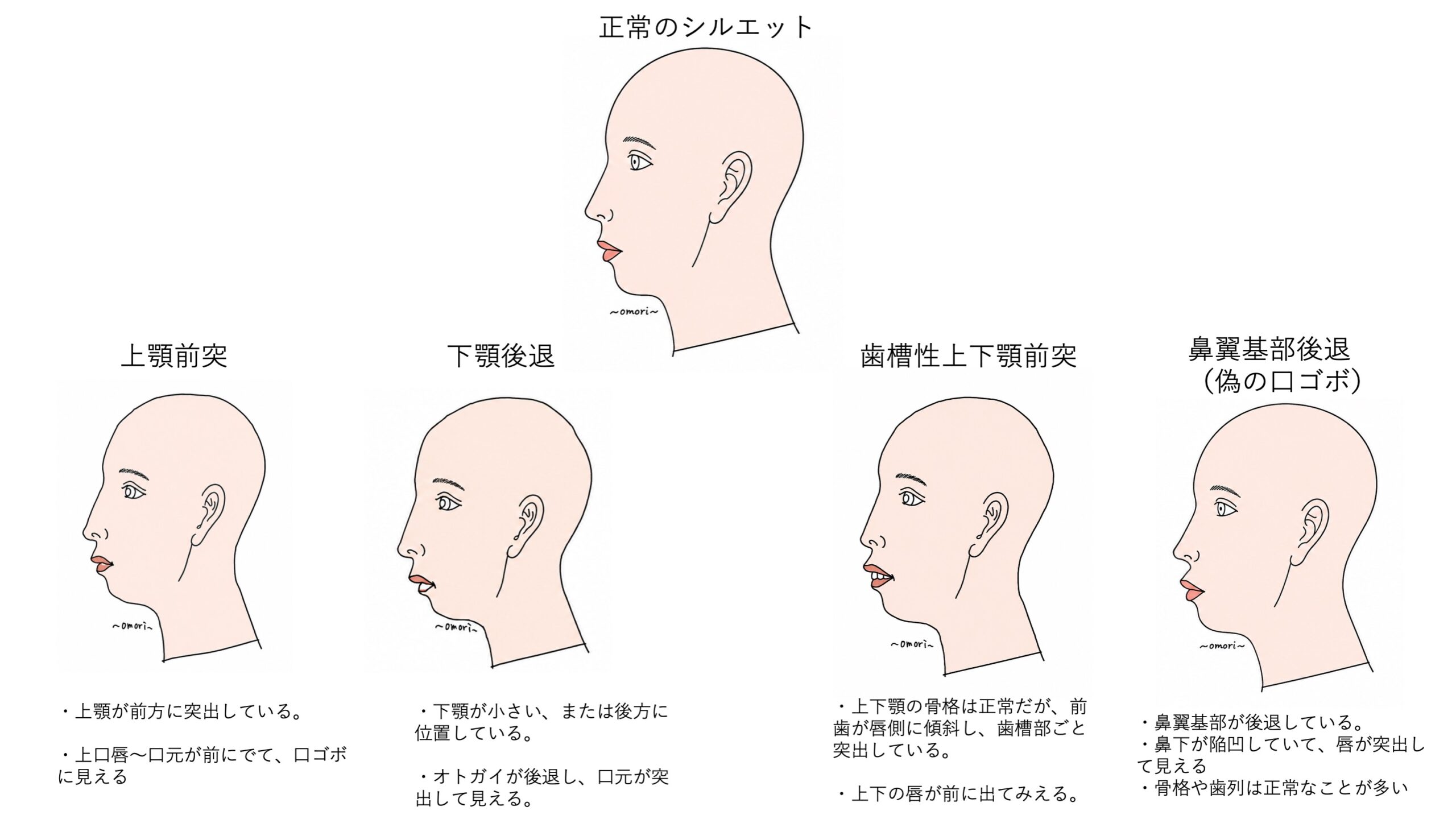 矯正しても口ゴボが治らない人へ　~ 原因は歯ではないかもしれません ~